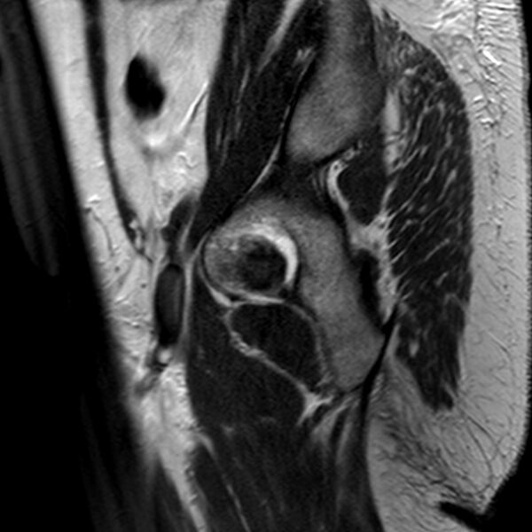 File:Adenomyoma of the uterus (Radiopaedia 9871-10439 Sagittal T2 1).jpg