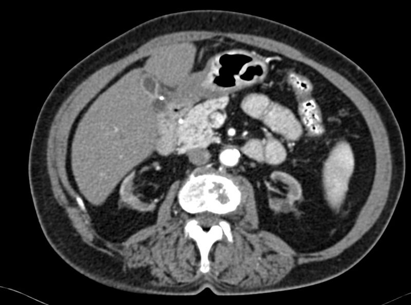 File:Adenomyomatosis of the gallbladder (Radiopaedia 12142-12483 Axial C+ arterial phase 14).jpg