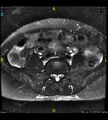 Adenomyosis (Radiopaedia 43504-46889 Axial T2 fat sat 3).jpg