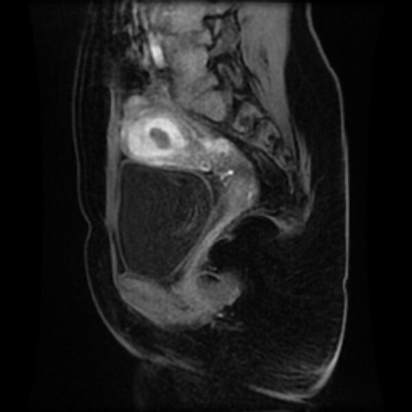 File:Adenomyosis within a septate uterus (Radiopaedia 69963-79981 Sagittal LAVA-Dyn 12).jpg