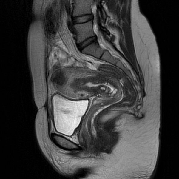 File:Adenomyosis within a septate uterus (Radiopaedia 69963-79981 Sagittal T2 17).jpg