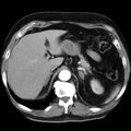 Adrenal hemangioma (Radiopaedia 11039-11445 Axial C+ arterial phase 4).jpg