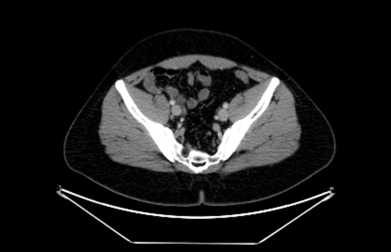 File:Adrenocortical carcinoma (Radiopaedia 80134-93438 Axial C+ portal venous phase 106).jpg