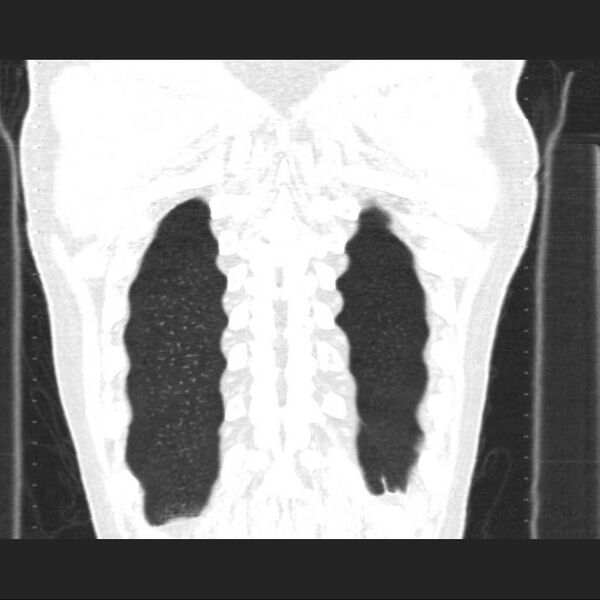 File:Allergic bronchopulmonary aspergillosis (Radiopaedia 21386-21320 Coronal lung window 17).jpg