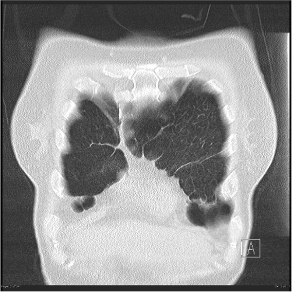 File:Alpha-1-antitrypsin deficiency (Radiopaedia 26537-26678 Coronal lung window 2).jpg