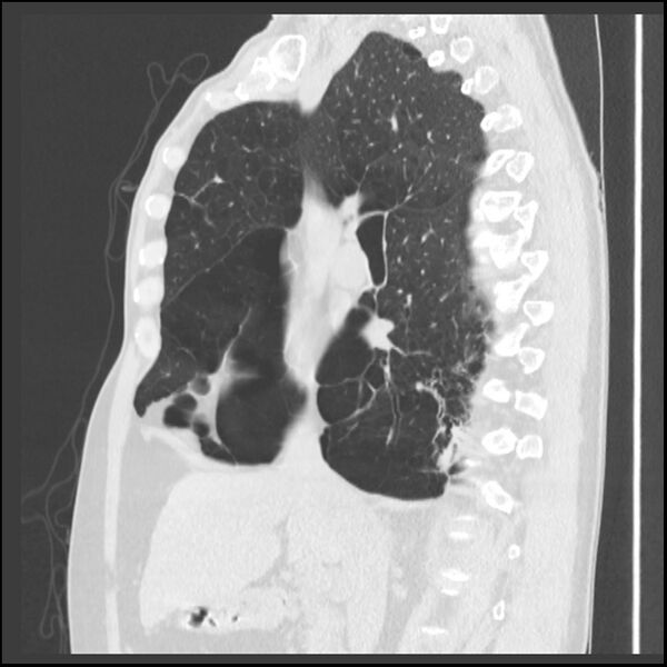 File:Alpha-1-antitrypsin deficiency (Radiopaedia 40993-43722 Sagittal lung window 155).jpg