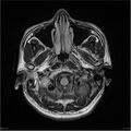Amnestic syndrome secondary to hypoxic brain injury (Radiopaedia 24743-25004 FLAIR 2).jpg