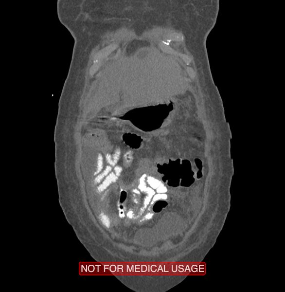 File:Amoebic enterocolitis with liver abscess (Radiopaedia 35100-36609 B 11).jpg