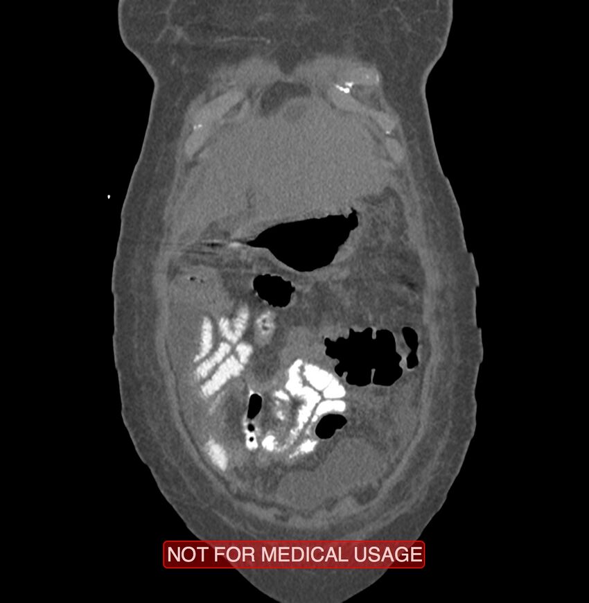 Amoebic enterocolitis with liver abscess (Radiopaedia 35100-36609 B 11).jpg