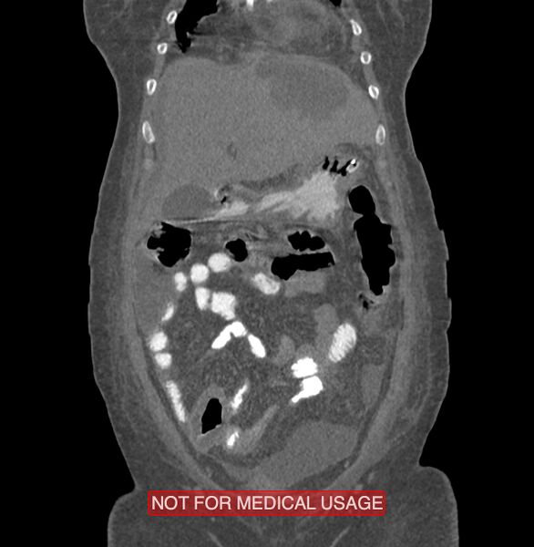 File:Amoebic enterocolitis with liver abscess (Radiopaedia 35100-36609 B 35).jpg