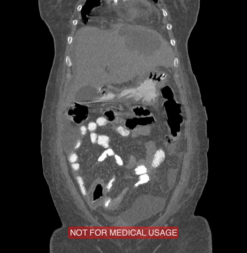 Amoebic enterocolitis with liver abscess (Radiopaedia 35100-36609 B 35).jpg