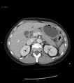 Ampulla of Vater metastasis (Radiopaedia 27820-28069 A 21).jpg