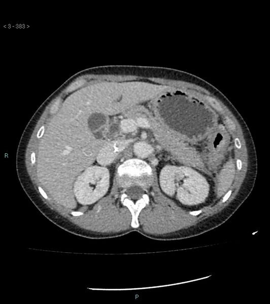 File:Ampulla of Vater metastasis (Radiopaedia 27820-28069 A 21).jpg