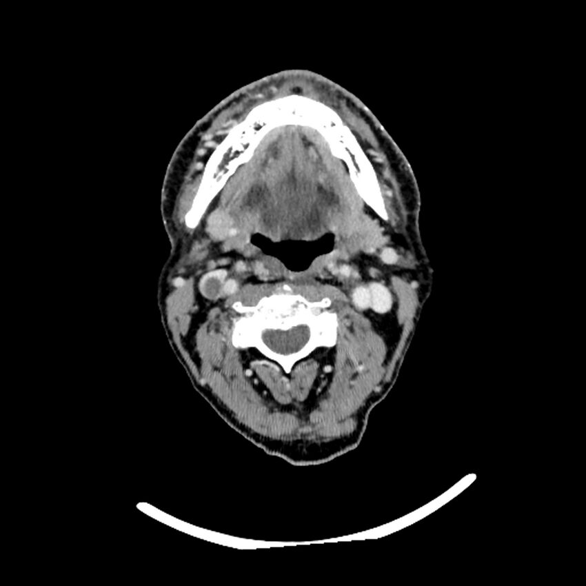 Anaplastic thyroid carcinoma (Radiopaedia 79087-92034 B 84).jpg
