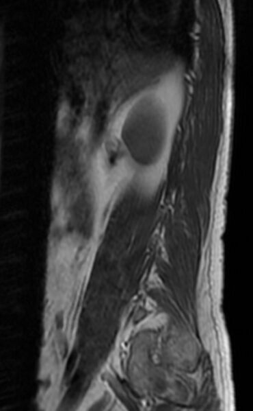 File:Ankylosing spondylitis - Andersson lesion (Radiopaedia 81878-95838 Sagittal T1 1).jpg
