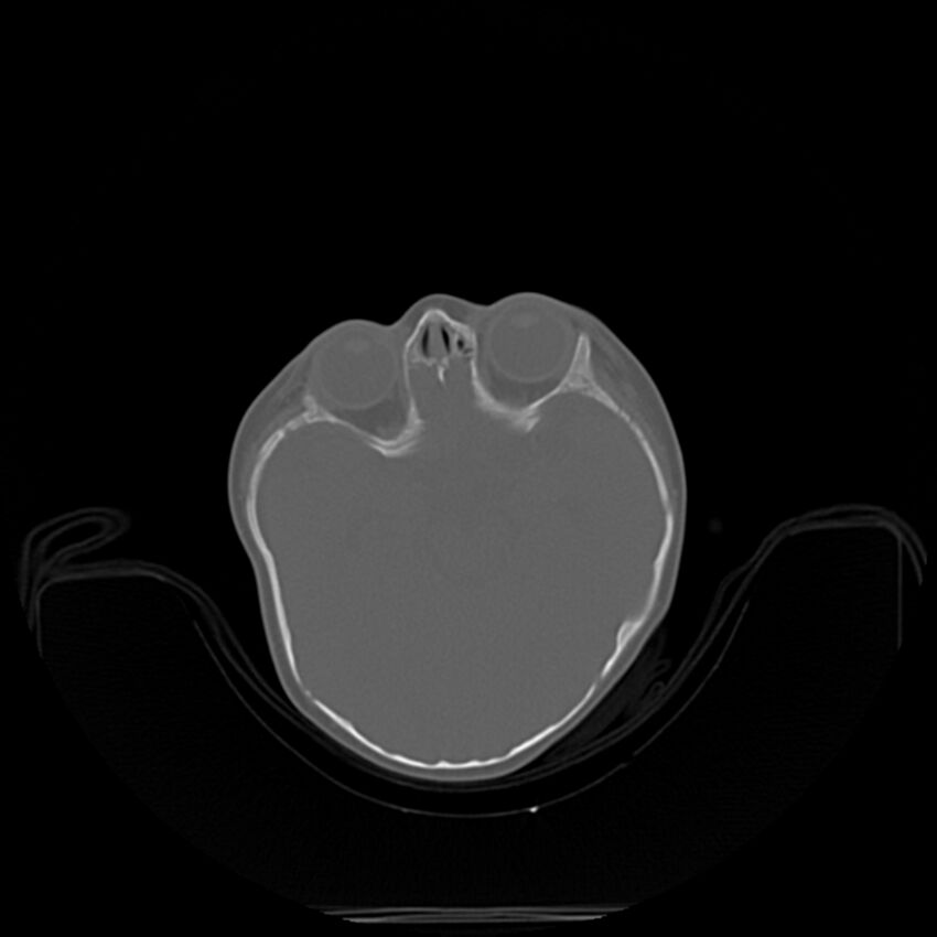Anterior plagiocephaly (Radiopaedia 71836-82273 C 13).jpg