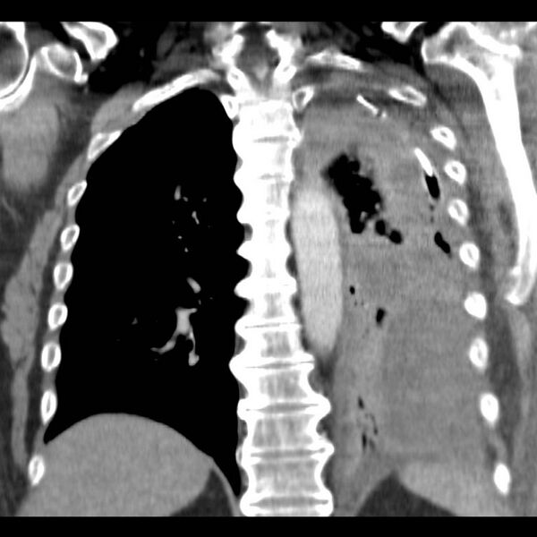 File:Aortic arch false aneurysm (Radiopaedia 14667-14588 B 15).jpg