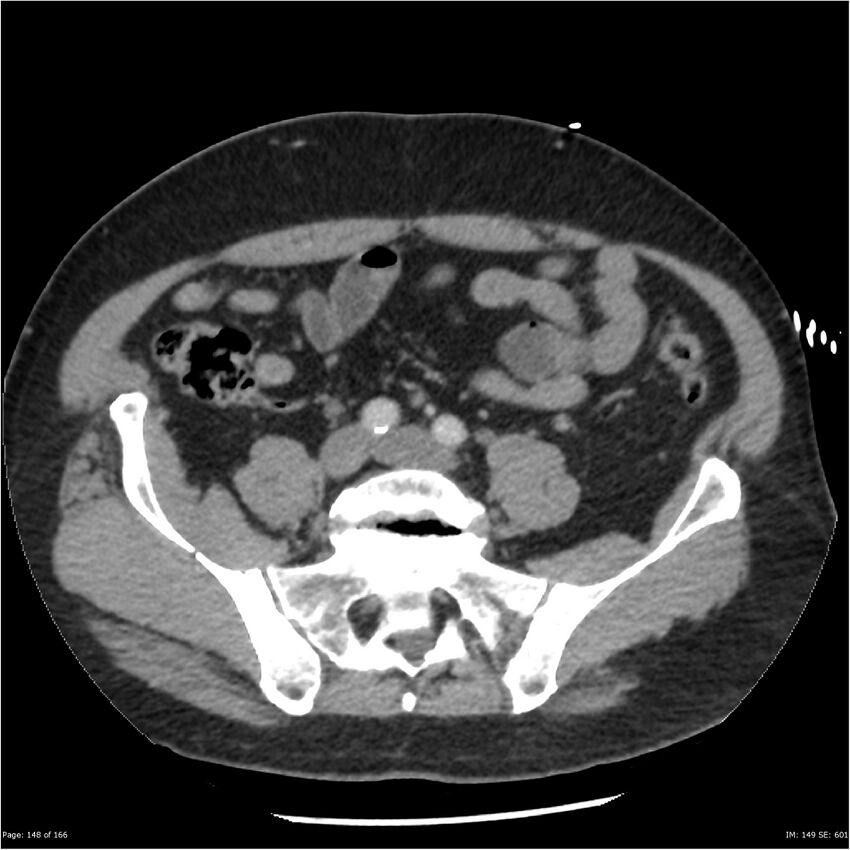 Aortic dissection- Stanford A (Radiopaedia 37759-39664 A 139).jpg