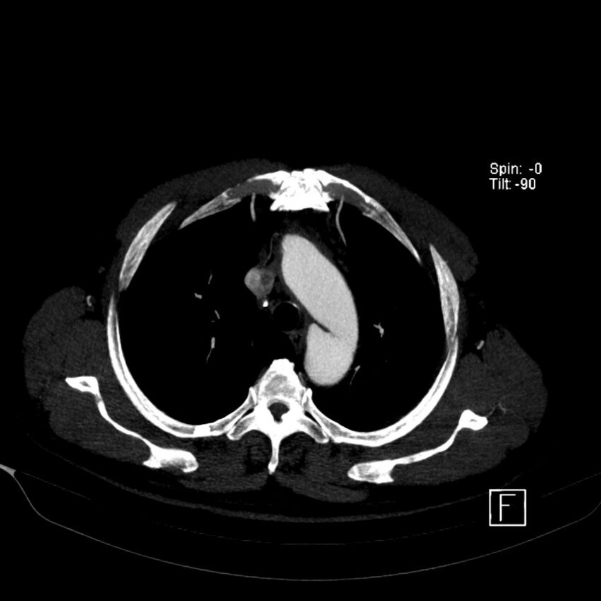 Aortic dissection - De Bakey type III - Stanford B (Radiopaedia 21903-21882 B 16).jpg