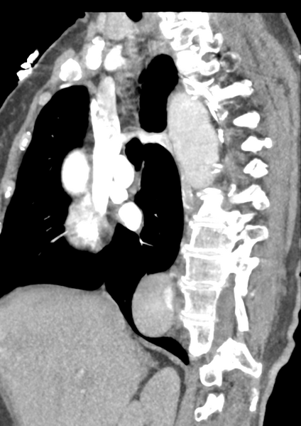 File:Aortic dissection - Stanford type B (Radiopaedia 50171-55512 C 38).png