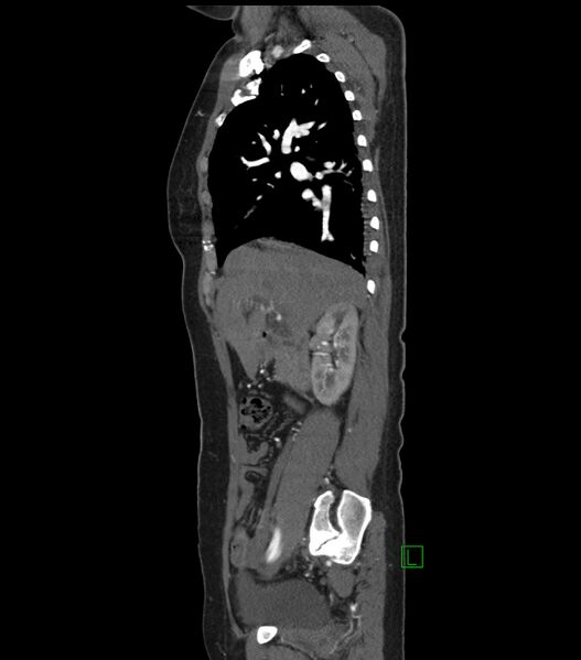 File:Aortic dissection with renal ischemia (Radiopaedia 76573-88338 D 2).jpg