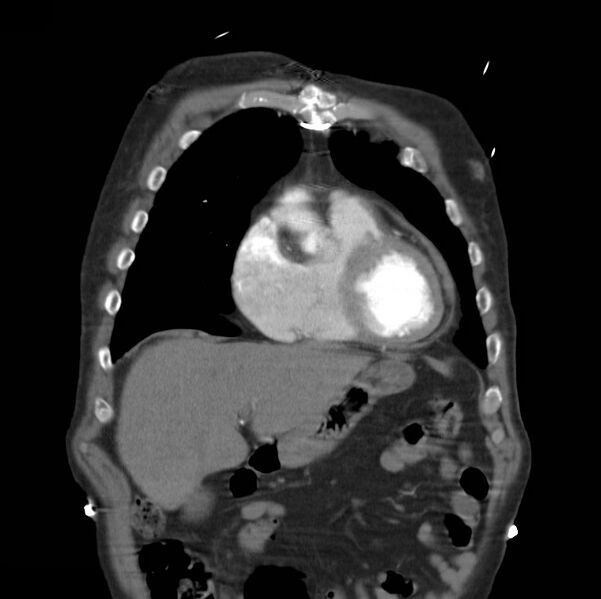 File:Aortic dissection with rupture into pericardium (Radiopaedia 12384-12647 B 8).jpg