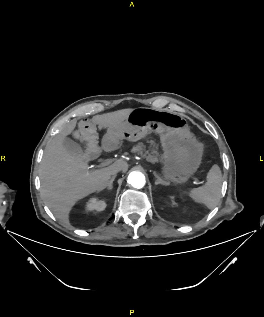 Aortoenteric fistula (Radiopaedia 84308-99603 B 66).jpg