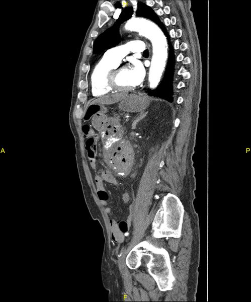 File:Aortoenteric fistula (Radiopaedia 84308-99603 C 217).jpg