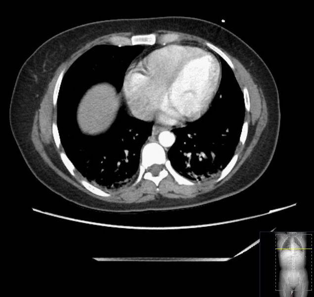 File:Appendicitis (CT angiogram) (Radiopaedia 154713-127660 Axial 184).jpg