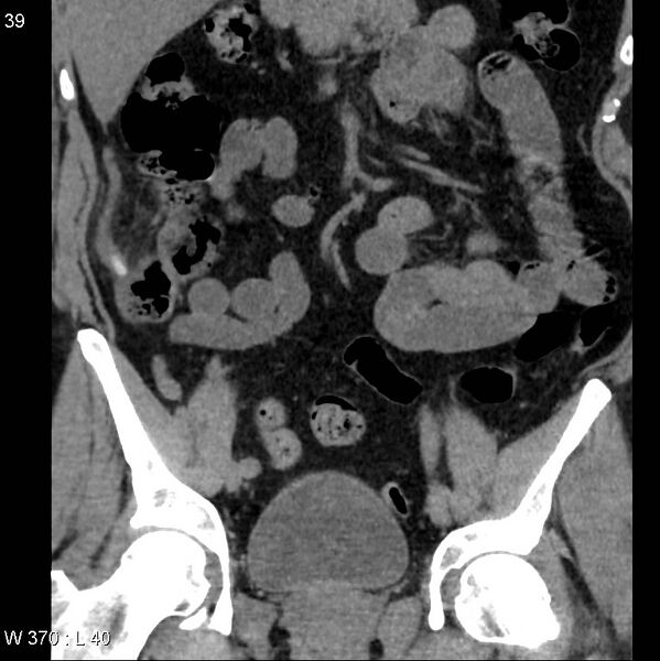 File:Appendicitis (Radiopaedia 12510-12733 Coronal non-contrast 9).jpg