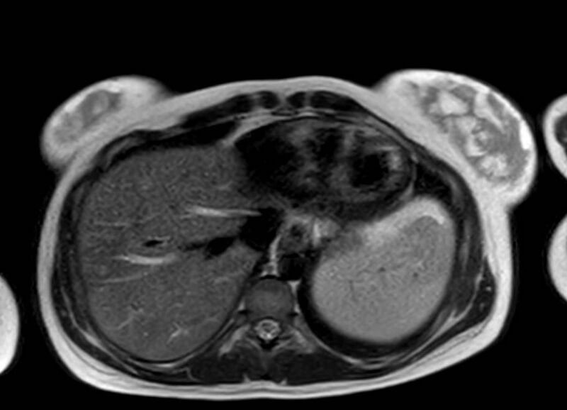 File:Appendicitis in gravida (MRI) (Radiopaedia 89433-106395 Axial T2 4).jpg