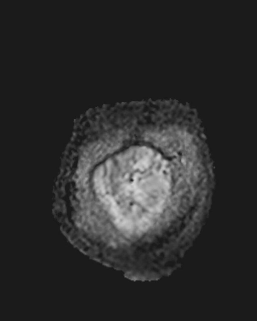 Appendicitis in gravida (MRI) (Radiopaedia 89433-106395 Coronal ADC 8).jpg