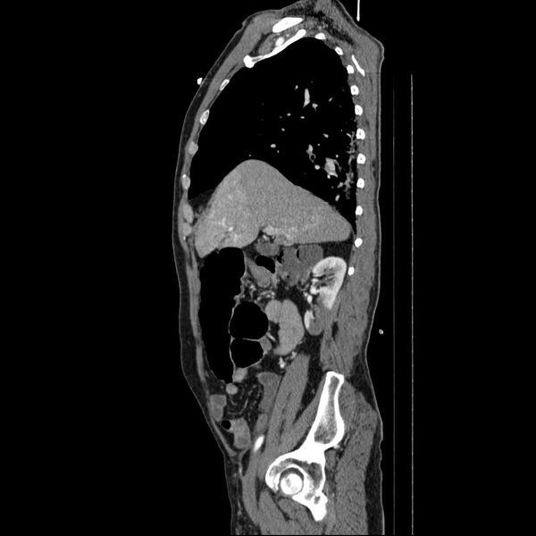 File:Appendicitis with cecal bar sign (Radiopaedia 31878-32830 B 62).jpg
