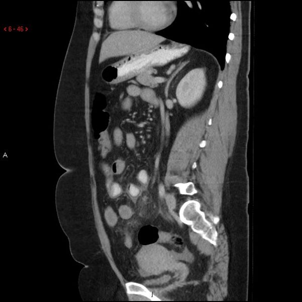 File:Appendicitis with microperforation- promontoric type (Radiopaedia 27268-27442 A 31).jpg