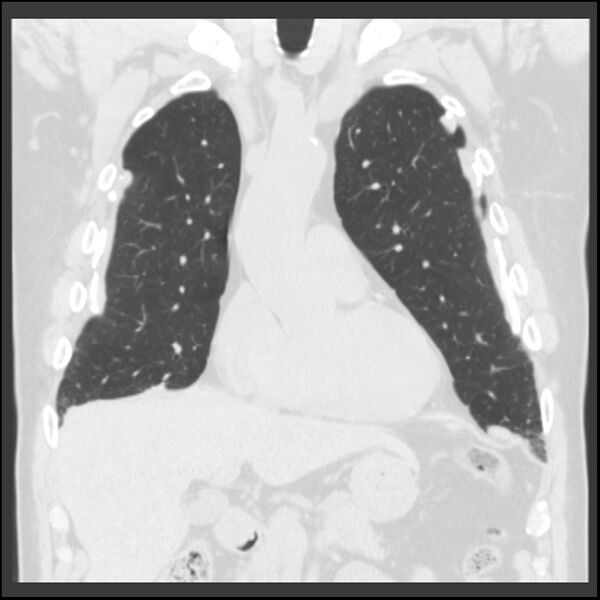 File:Asbestos-related pleural plaques (Radiopaedia 39069-41255 Coronal lung window 61).jpg