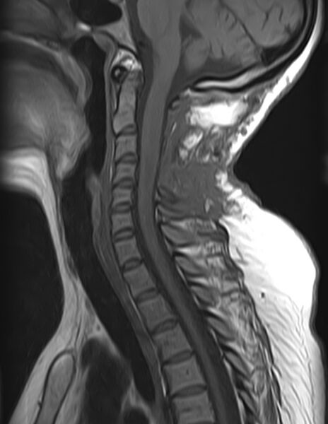 File:Astrocytoma - spinal cord (Radiopaedia 69769-79758 Sagittal T1 6).jpg