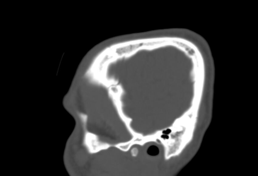 Asymptomatic occipital spur (Radiopaedia 87753-104201 Sagittal bone window 21).jpg