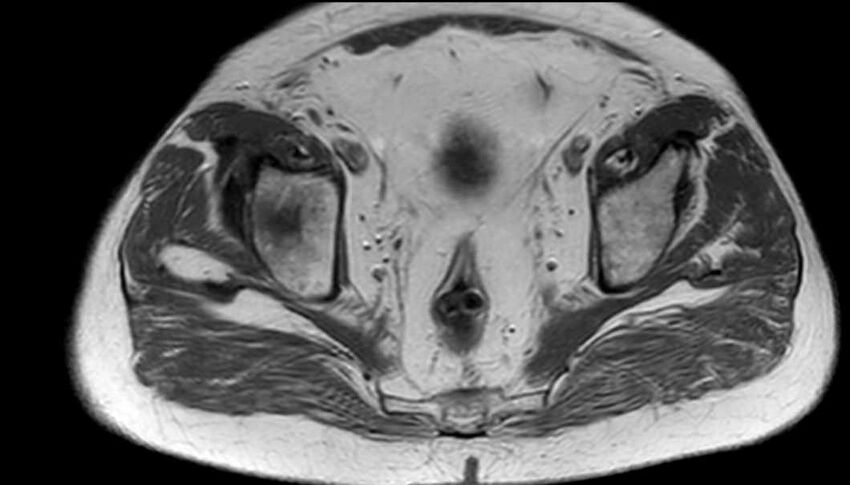 Atypical lipomatous tumor - thigh (Radiopaedia 68975-78734 Axial T1 99).jpg