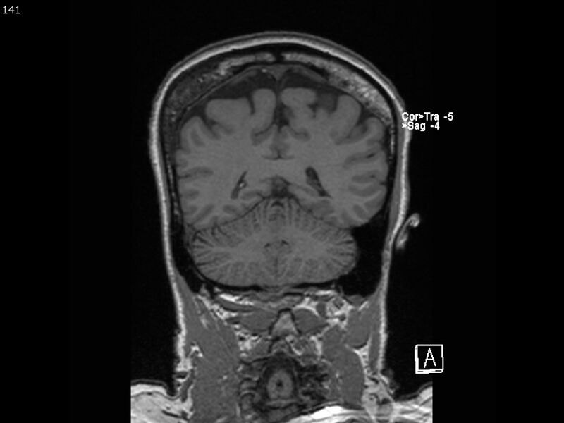 File:Atypical meningioma - intraosseous (Radiopaedia 64915-74572 Coronal T1 141).jpg