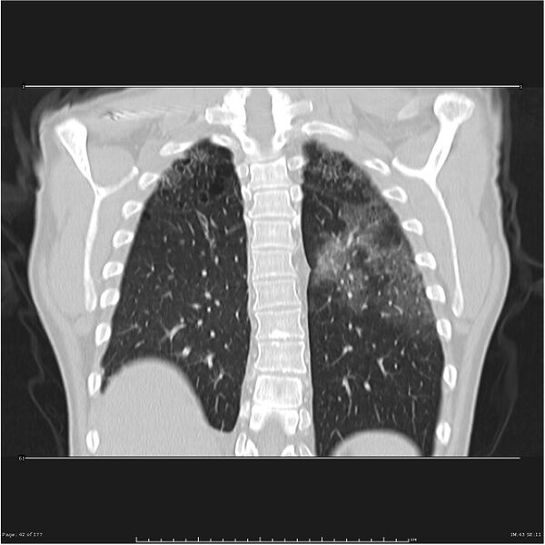 File:Atypical pneumonia - Q fever (Radiopaedia 21993-21989 C 35).jpg