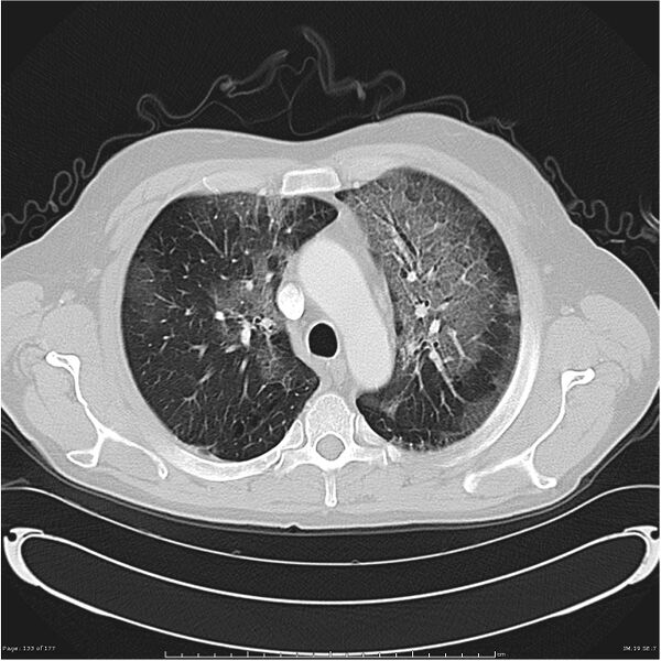 File:Atypical pneumonia - Q fever (Radiopaedia 21993-21989 lung window 12).jpg