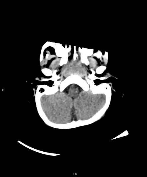 File:Basal ganglia and parenchymal ischemia (Radiopaedia 45818-50083 Axial non-contrast 38).jpg