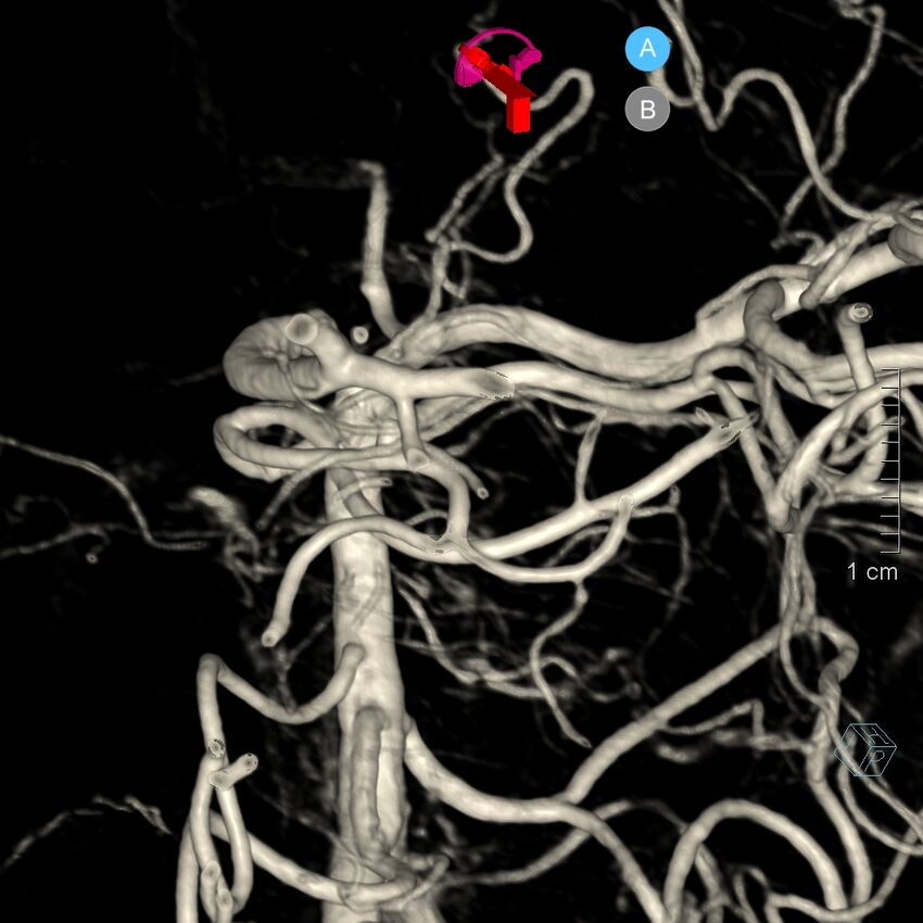 Basilar artery perforator aneurysm (Radiopaedia 82455-97734 3D view left VA 170).jpg