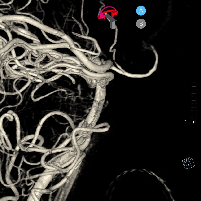 Basilar artery perforator aneurysm (Radiopaedia 82455-97734 3D view left VA 70).jpg