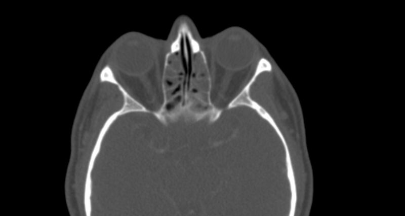 File:Benign mixed salivary tumor of the parotid gland (Radiopaedia 35261-36792 Axial bone window 1).jpg