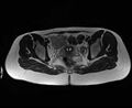 Bicornuate bicollis uterus (Radiopaedia 61626-69616 Axial T2 24).jpg