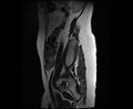 Bicornuate bicollis uterus (Radiopaedia 61626-69616 Sagittal T2 5).jpg