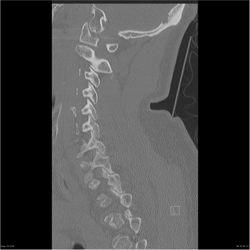 Bilateral cervical ribs (Radiopaedia 25868-26017 Sagittal bone window 24).jpg