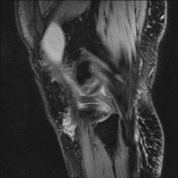 File:Bilateral focal pigmented villonodular synovitis (Radiopaedia 67643-77073 Sagittal T1 vibe 11).jpg