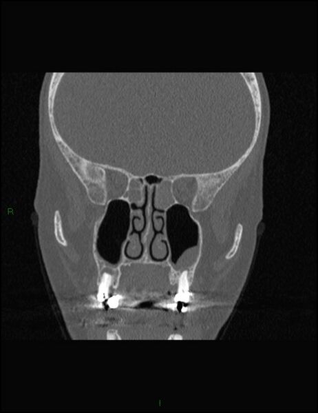File:Bilateral frontal mucoceles (Radiopaedia 82352-96454 Coronal 168).jpg